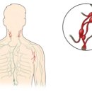 비호지킨 림프종[Non-Hodgkin lymphoma]종양혈액질환 이미지