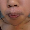 맑은우리들약국 | 해외 약사, 캐나다에서 인생 최악의 피부염 극복 후기