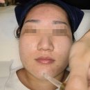 하베레피부전문센터 | 남포동 피부관리 사하구 여드름 압출 잘하는곳 하베레피부전문센터 재방문후기
