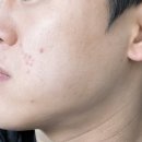 광명한의원 | 광명 피부과 한의원, 여드름 패인흉터 새살침 2회차 치료 솔직후기, 살이 차고있어요
