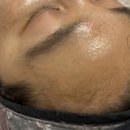 다산 피부관리 [아이퀸에스테틱] PHA물톡스 후기