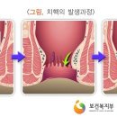 변비, 임신, 노화가 원인? 여성에게 흔한 '치핵' 이미지