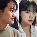 반듯한교정치과기공소 | 주걱턱 옆모습 변화, 교정 비용 써본 현실 후기