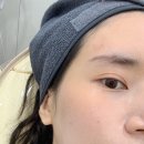강남의원 | 강남피부과 아쥬르의원 이마필러가격 엘라스티 효과 후기