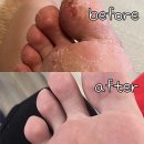 참바른약국 | 무좀약 라미실 약국 가격 추천 사용법 찐후기임 ㅋ