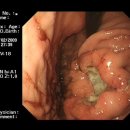 Gastric ulcer metastatic melanoma 01 이미지