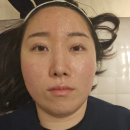 [부산 에스테틱 / 화명동] 피부개선 치트키! &#34;바이디온&#34; 여드름 굿바이 프로젝트 1주차