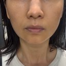 휴스킨 - 광산구 | 계산동 휴스킨앤바디 윤곽관리 받아본 후기(아픈만큼 예뻐질까?)