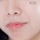208-운정3-208 | 여드름 압출|문제성 민감성 모공 피부샵::혜본스킨 방문 후기 (10/6 운정역 도보5분 리뉴얼 오픈예정🌟)