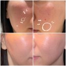 단비한의원 | 피코프락셀 vs 포텐자 레이저 vs 상계역한의원 새살침 내돈내산 후기, 차이점(ft. 4회차)