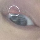 새봄안과의원 | 대전 유성구 안과 '새봄안과의원' 다래끼 치료 후기