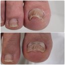 마음의 힐링 - 향기로운 독서심리치료 | 🦶 천안 내성발톱 발톱무좀 관리 전문가! 19년 경력 레푸스 두정점 솔직 후기