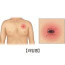 라임병(Lyme disease) 감염성 질환, 피부질환이란? 이미지