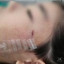 센트럴성형외과 | 상식]아이 얼굴 찢어 졌을때-아이 얼굴 상처 봉합/주말 진료 성형외과/아이 얼굴 봉합 쏘울성형외과 후기