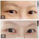 차이한 | 눈밑지방재배치 수술 비용 차이와 한달 회복기간 후기
