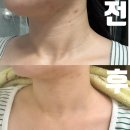강남역목주름 필러 콜라레쥬 내돈내산 만족 후기
