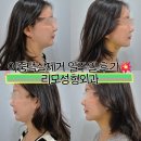 리얼성형외과의원 | 💉 이중턱 지방흡입 &amp; 근육묶기 리얼후기🏥 리모성형외과 | 이호준 대표원장 시술
