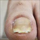 삼산길 | 영천 하양 내성발톱 무좀발톱까지 복합관리 후기 재은네일뷰티 페디크루 영천점