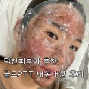 덕천광고 | 덕천피부과 골드PTT + 제네시스레이저 6회 패키지 후기