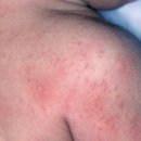 알레르기 이미지