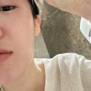 멍스낵 | 속건조 시술 리쥬란 주사자국, 멍, 엠보 기간 등 다운타임 길지 않았던 후기