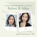 부산 센텀시티역 근처 프락셀레이저와 색소레이저(목주름, 잡티) 내돈내산 시술후기