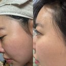 큐어람한의원 | 강남역 편평사마귀 성지 큐어람한의원 다운타임 없는 정우고 도포 내돈내산 후기