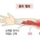 골프엘보 통증 원인 예방법 이미지