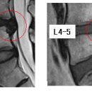 레알 님의 요추디스크 L4-5 MRI 판독입니다. 이미지