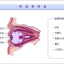 안검 경련증 이미지