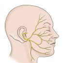 안면마비. 구안와사. 벨마비.(Facial palsy)