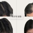 대구SMP | 대구 SMP 두피문신 후기, 탈모 고민으로 잃은 자신감 찾은 이유