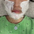 강남JC성형외과의원 | 강남 하니성형외과 울쎄라 후기&amp;예비신부 리프팅 추천천 (실제 시술 경험)