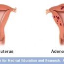 자궁선근증[adenomyosis] 이미지