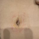 바로편안성모의원 | 부평담석증 성모K외과 치료 후기