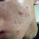 새로나세탁 | (혐/스압)현실적인 여드름극복기/로아큐탄 후기/ 팩트만말