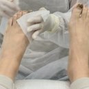 레푸스 구월점 내성발톱 무좀발톱 발각질 문제성발 이미지