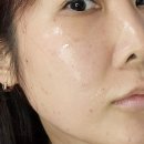 서울대입구백세한의원 | 서울대입구 편평사마귀 제거 비립종까지 싹 나아진 후기