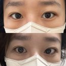 듀얼랜드 | 신중동 언더펌 잘하는 곳 끌리비 듀얼펌 후기｜재방문 의사 100%