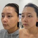 대구 온다리프팅 대신 아미뷰티 페이스리프팅 후기 유지기간