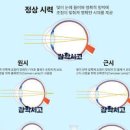 시야흐림 원인 시력 회복 좋아지는법 운동 이미지