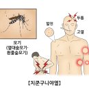 치쿤구니야열[Chikungunya Fever]감염성 질환 이미지