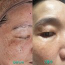 프라자 크리닝 | 검단 김포 기미 피부관리 비비드엘 케어후기