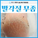 서원장 | 울산 발각질 관리 양말에 걸리고 갈라진다면 각화형무좀 일 수 있어요