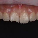 한결치과기공소 | [앞니 심미 치료] 불의의 사고로 깨진 앞니, 하루 만에 자연스럽게 복구한 &#39;PFZ 지르코니아 크라운&#39; 후기