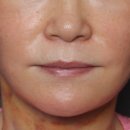 샤프(SHARP)성형외과의원 | 안면거상 붓기 일주일 한달 지나도 안 빠진다면? (대표원장님 답변)