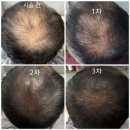 미스터블랙뷰티 | SMP 몇 번 받아야 하나요? | 1차~3차 변화 과정 사진으로 비교해봤어요