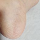 골든메디 | 갈라진 발뒤꿈치 보습제! 100% 골든 호호바 메디 오일 후기