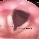 성대결절[vocal nodules] 이미지