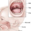 아데노이드 비대증 증상 및 치료 제거 수술 (코골이 원인, 구강호흡, 만성부비동염) 이미지
